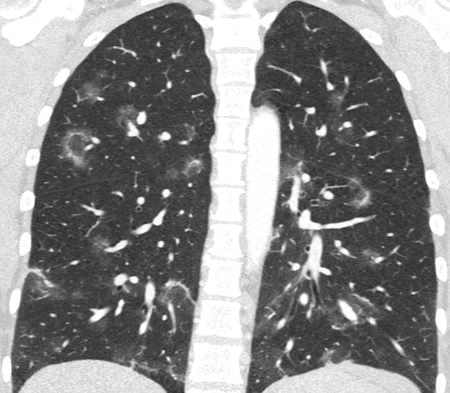 Expertise vertiefen: Die neue Zusatzqualifizierung Thoraxradiologie